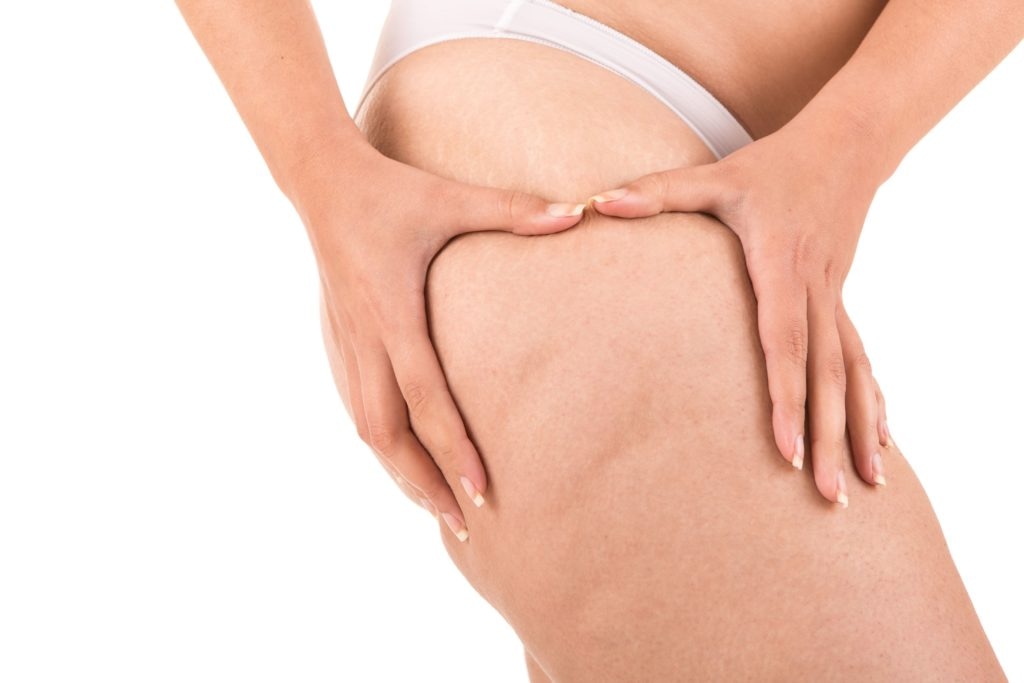 Wie Frauen ihr eigenes Lipödem erkennen können: Praktische Tipps