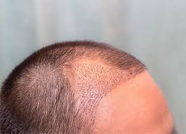 Transforming Your Hairline: Haartransplantation Türkei Kosten Mastery
