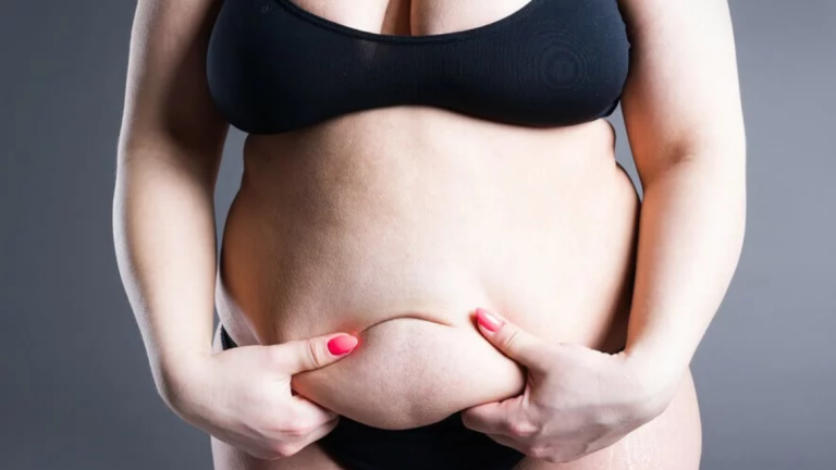 Pubertät, Schwangerschaft und Lipödem: Warum Frauen besonders betroffen sind